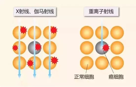 質(zhì)子重離子技術(shù)醫療險可以報銷(xiāo)嗎？