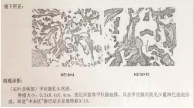 別慌，甲狀腺疾病還可以這樣投保！